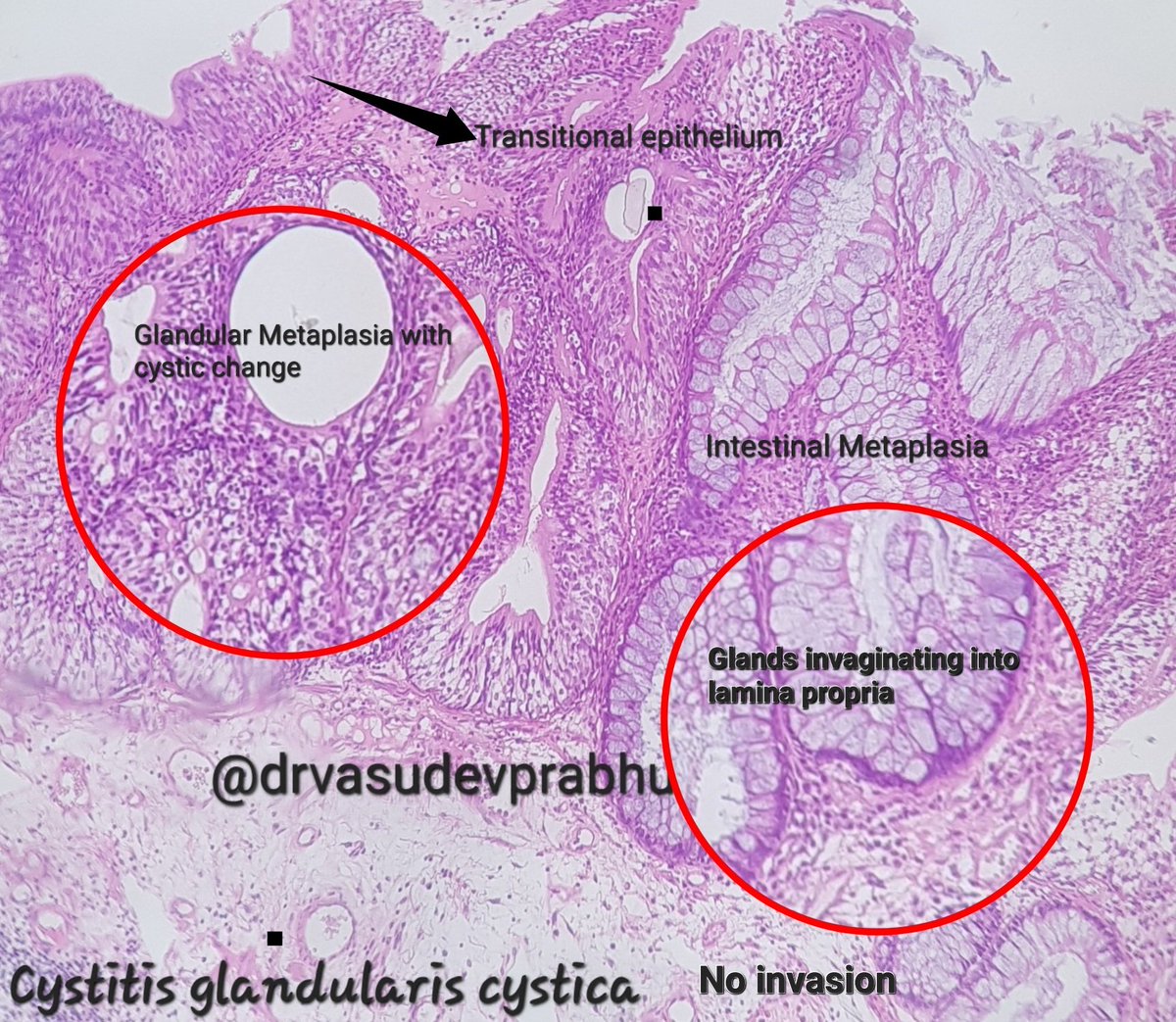 DrVasudevPrabhu's tweet photo. For the residents and teaching enthusiasts 🔬✌️
Cystitis glandularis cystica.
🔬Reactive metaplastic change due to chronic inflammation
🔬Cystic change, intestinal Metaplasia
🔬No invasion/atypia
#pathboards #pathspotters #PathTwitter @anjuthevirgo @DrApoorvaN1 @RizviUroos https://t.co/RxmlxynKqs