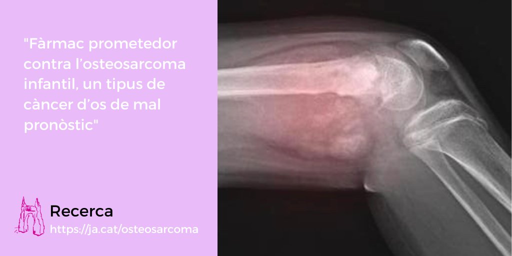 Farmacia_UB's tweet photo. #FarmaciaUB | L’osteosarcoma infantil és un tipus de càncer de mal pronòstic que es desenvolupa a les cèl·lules que formen els ossos 🦴. Un equip de @Farmacia_UB de la @UniBarcelona  està duent a terme un fàrmac prometedor per fer-hi front.

🚩 https://t.co/9BOtn343HW https://t.co/v0UoB3NL4P