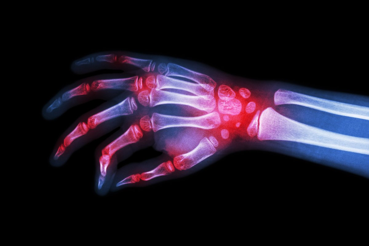 physiospot's tweet photo. What Do You Need To Know To Effectively Manage Psoriatic Arthrit’is?  https://t.co/L0F7VtGhVY https://t.co/NFrFZ3WMEF