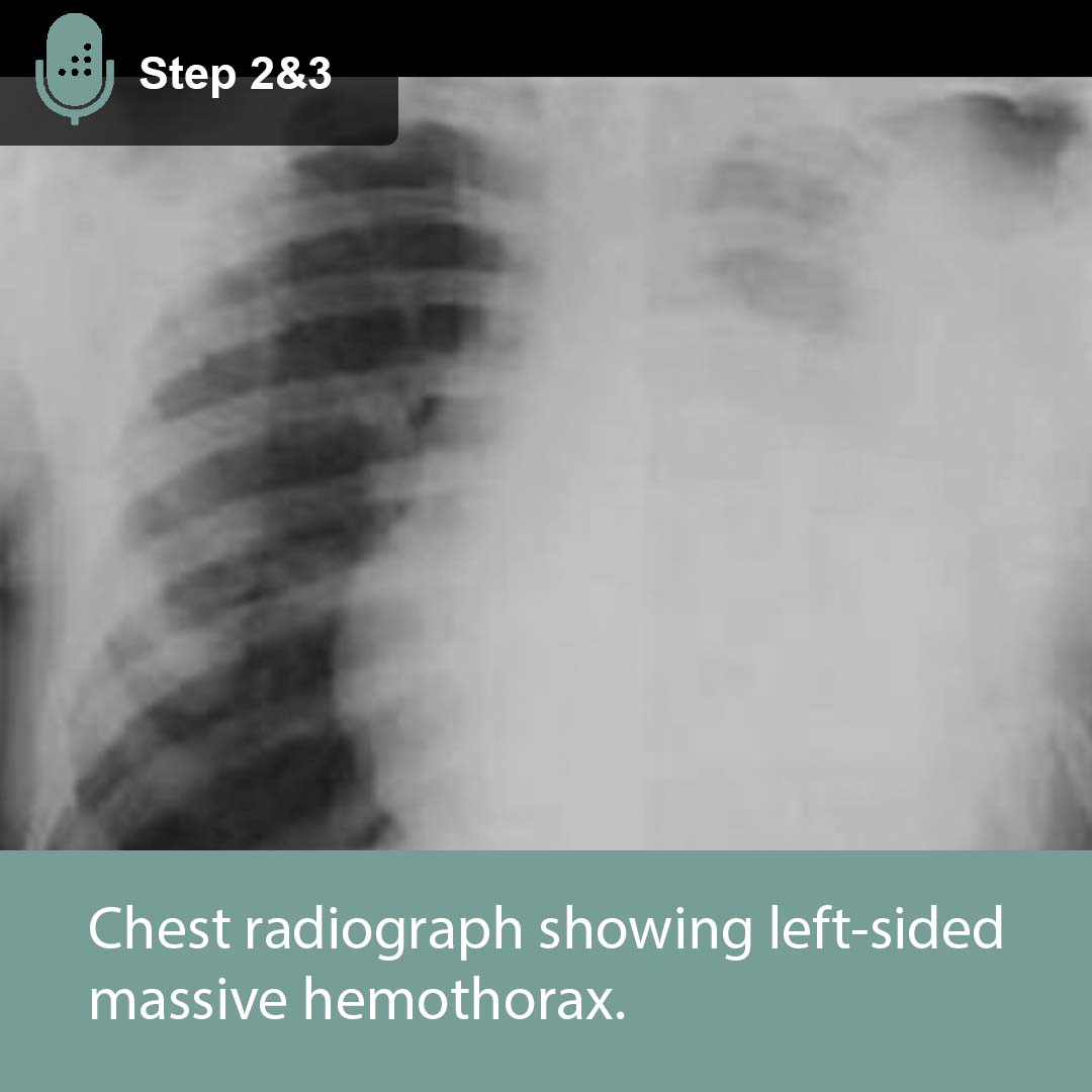 Left Hemothorax X Ray