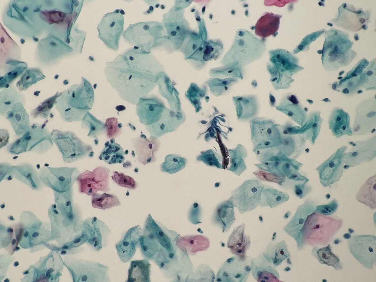 elimoreymd's tweet photo. Aloha! Missing the garden isle….. Found this on a recent pap! #cytotec #gynpath #cyto #hawaii #PathTwitter https://t.co/iNYPO5wtEl