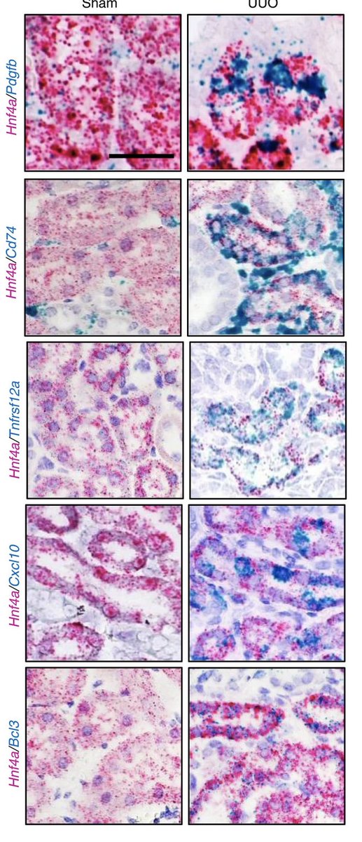 NatImmunol's tweet photo. How fibrosis and inflammation are integrated is not entirely clear. Susztak and colleagues show that profibrotic proximal tubular cells in the kidneys recruit basophils and activate them to produce interleukin-6 and drive TH17 cell responses https://t.co/Vq4BMiVQRU https://t.co/1qoaBkqZT3