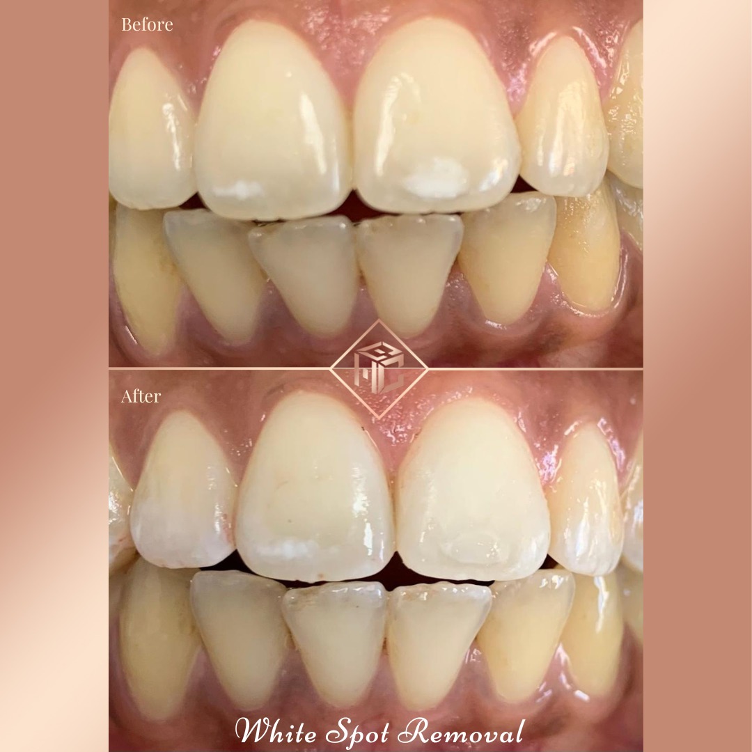 ✨ ICON TREATMENT ✨

Do you have any white spots or white patches on your front teeth?

Theses can be cause by eating sugary foods, after removing braces you may notice them, consuming too much fluoride or just developmental!

We now offer a treatment that can help with this!