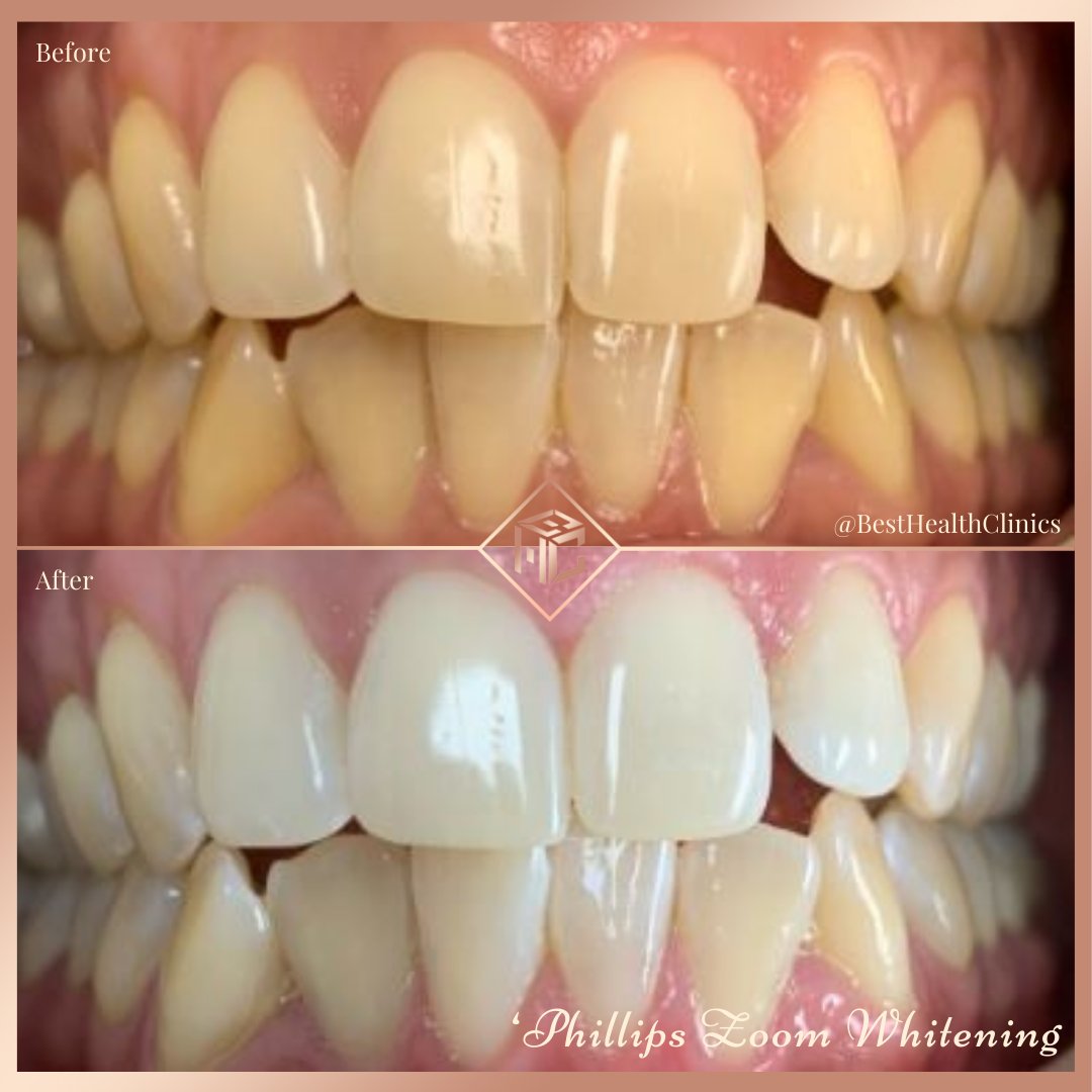 Another beautiful smile done by Dr Ayesha using the Phillips Zoom Whitening 🦷

🦷 - One hour in surgery session and also pain free!

To get booked in -
📞call us - 01708 477 577
📧 email us - info@bhclincs.com