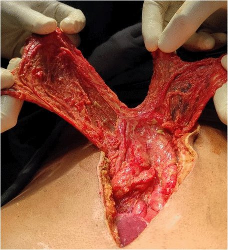 Dhananjayasha19's tweet photo. Giant prepyloric perforation (size >2 cm) is a challenging surgical problem. A combination of omental plug and patch techniques provides double protection against leakage. Such a simple and effective idea! https://t.co/YKhwizFfCQ