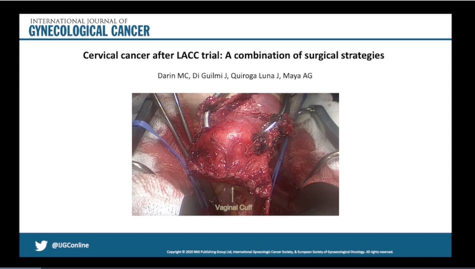 CeciliaDarin1's tweet photo. Current issue @IJGConline #videoarticle #cervicalcancer & #surgicalstrategies 🔗 https://t.co/kiz2tgzHsj
@OncoAlert @IGCSociety @ESGO_society @IJGCfellows @HsuMd @aagonco @quiroga_joha https://t.co/1bYY1Zxzle