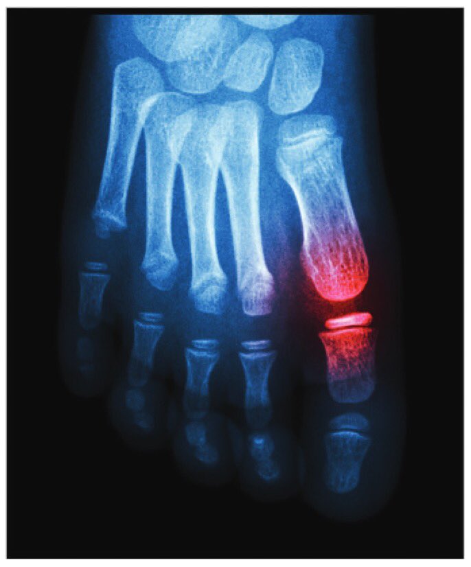DrJustinAlbert1's tweet photo. Is ankle injury harmful to one’s mental health?

Read about this and more in the Bone &amp; Joint 360 April issue Foot &amp; Ankle Roundup.

#footinjury #mentalhealth  #orthotwitter

https://t.co/JcX2e82atj https://t.co/nGW2rjmhTc