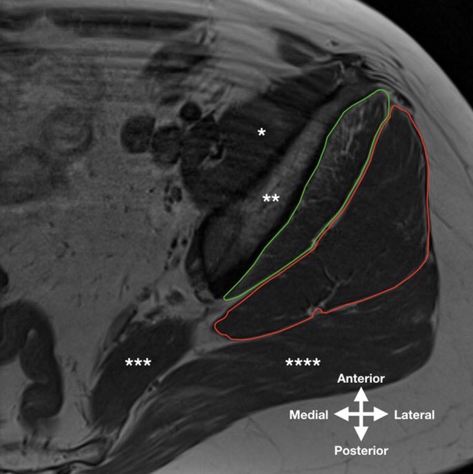 DrJustinAlbert1's tweet photo. Study reports end-stage osteoarthritis is associated with high levels of fatty infiltration in the anterior part of the gluteus minimus and medius and atrophy of the gluteus minimus.

#arthritis #orthotwitter #openaccess

https://t.co/bnyKASkTwF https://t.co/3135RYQei9