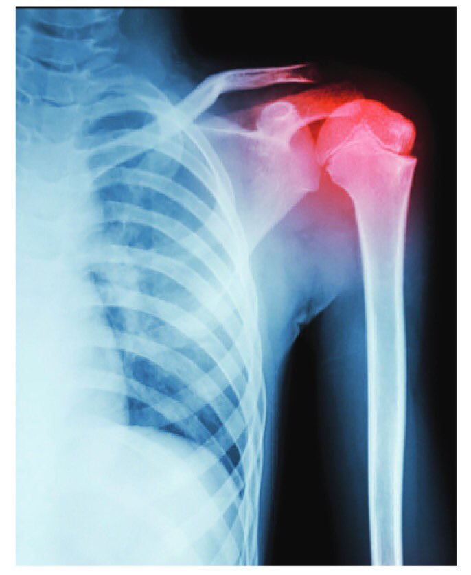 woolley_dr's tweet photo. Changing epidemiology of proximal humerus fractures…but has management changed? Hemiarthroplasty for distal humerus fractures…what are the long-term results?

Find the answers &amp; more in this issue's Shoulder &amp; Elbow Roundup!

#arthroplasty #ortho

https://t.co/9RWMXCqdId https://t.co/0mO0HJGtnf