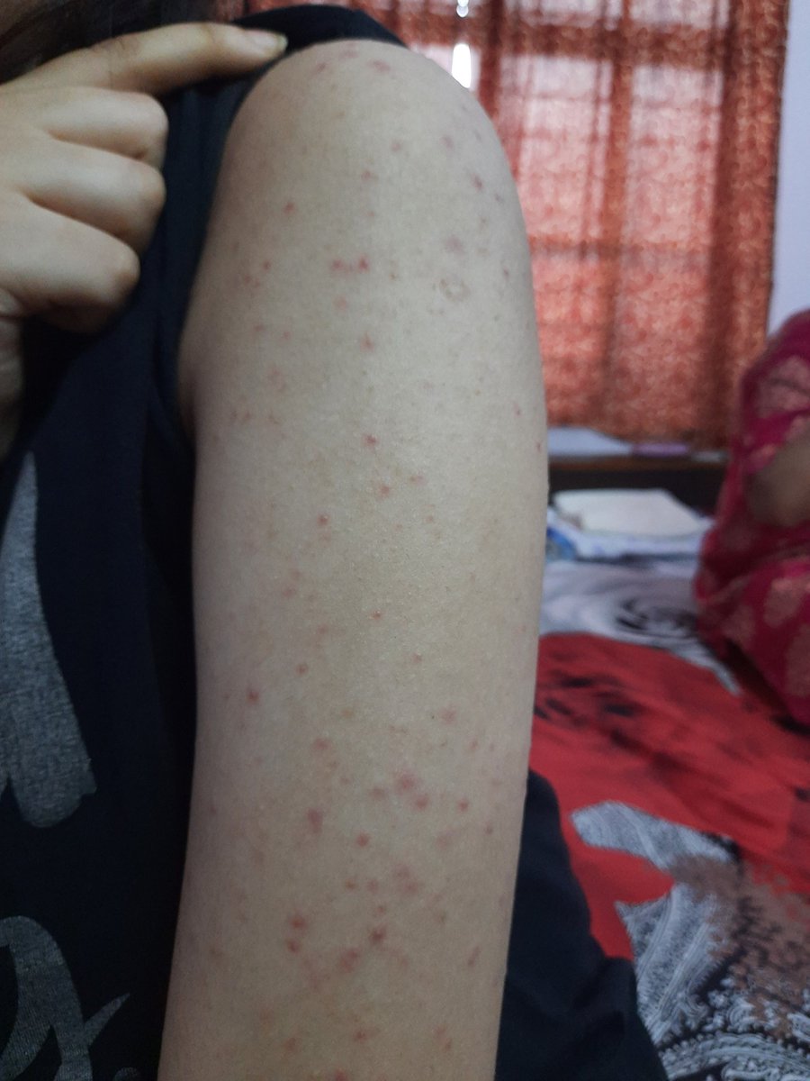 Ameesha_Dixit's tweet photo. I was traveling frm Jaipur-Jhansi on 10-05-22 using the dirty sheets and linen provided in AC 3 tier,I have got this serious bed bug bites. what is this Swachh Bharat?
Train no‐19666
Pnr- 2237589487,B2
@indianrailway__ @RailMinIndia @AshwiniVaishnaw @CPRONCR @DrmJhansi @DRMJaipur https://t.co/Idl2VMtKTJ