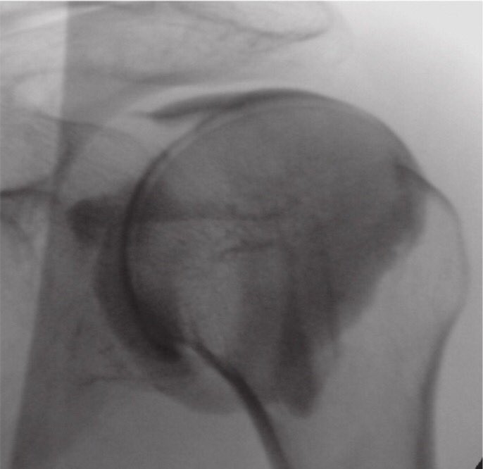WalkerRo2's tweet photo. Considering that it is both costly &amp; time-consuming, an US-guided intra-articular injection of corticosteroid seems not always to be necessary in the treatment of frozen shoulder as it gives similar outcomes as a blind injection.

#shouldersurgery #ortho

https://t.co/UXuowiLogd https://t.co/EezBexe8uU