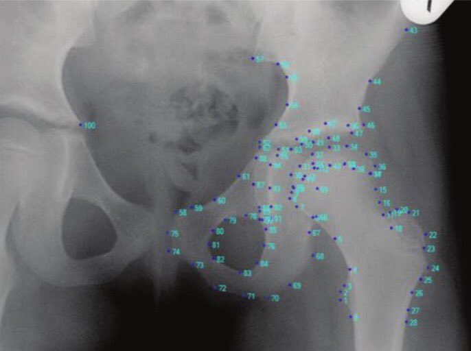 WalkerRo2's tweet photo. New article reports statistical shape modelling on the #pelvis radiograph of DDH hips with AVN allowed identification of femoral joint shapes associated with poor outcome. Recognizing these shapes at an early age could improve the outcome https://t.co/yFCuD0zmfQ #ortho https://t.co/UngoJSdDSE