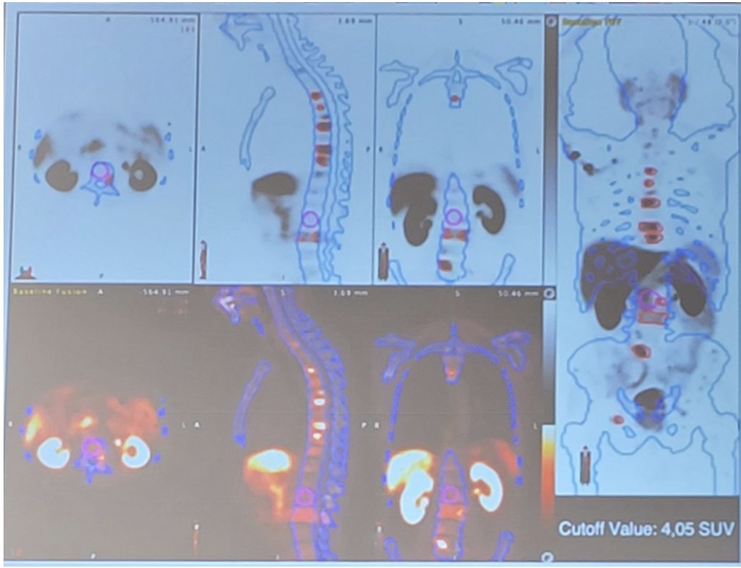urotoday's tweet photo. #ArtificialIntelligence PET interpretation vs human specialists: The #LATAM study. Presentation by @DBarreiro4. #AUA22 written coverage by @zklaassen_md @GACancerCenter > https://t.co/RgKHsqtQIi @AmerUrological https://t.co/fWuyF89qBE
