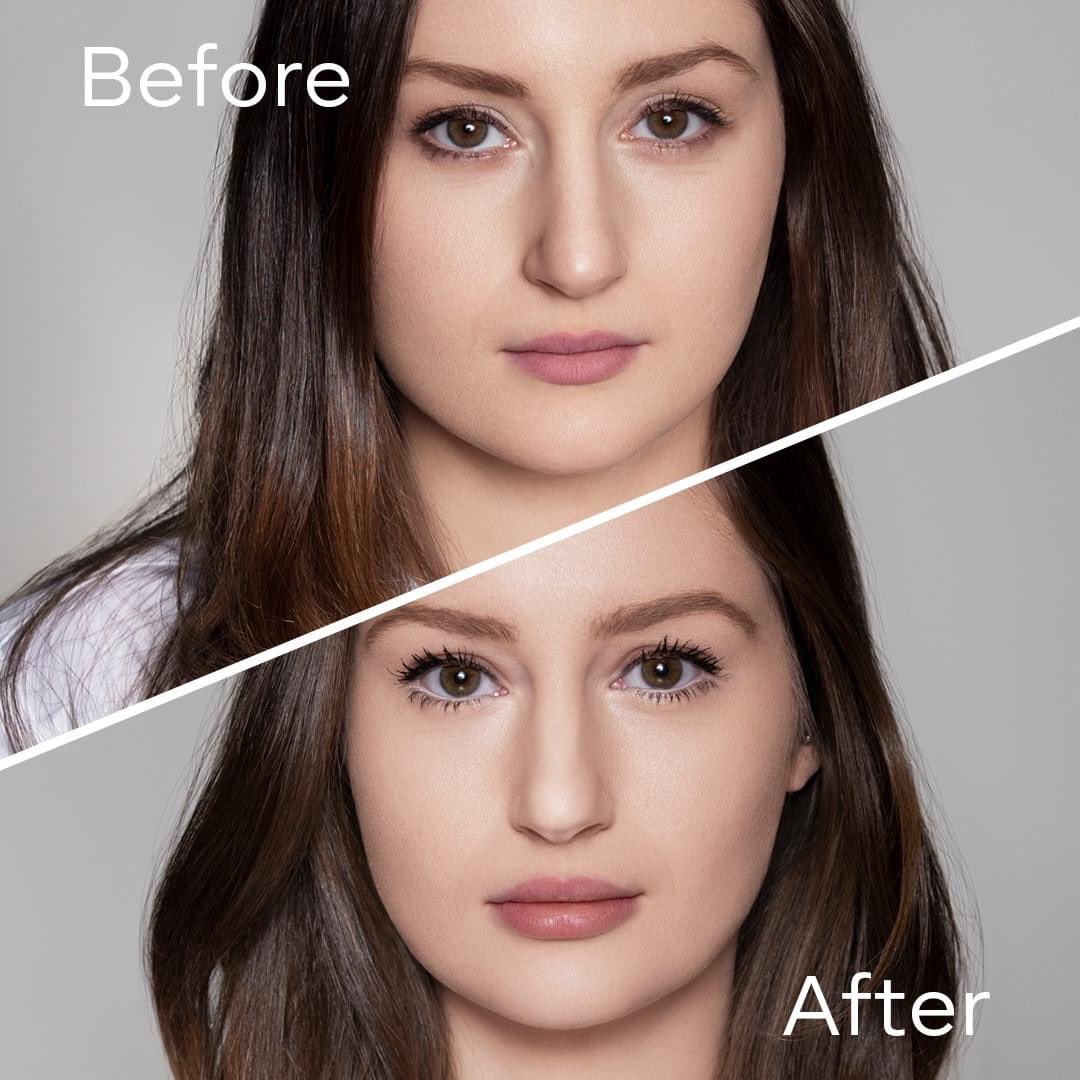 abmmedical's tweet photo. Defyne that Chin with Restylane. Here’s an example of natural-looking contouring with Restylane® DEFYNE™ 🌸💕
A filler in other words! (818) 222-8042 all procedures are performed by board certified physicians ✔️
#galderma #aesthetics #restylane #restylanedefyne #skinstories https://t.co/rU2yMiY6Hm