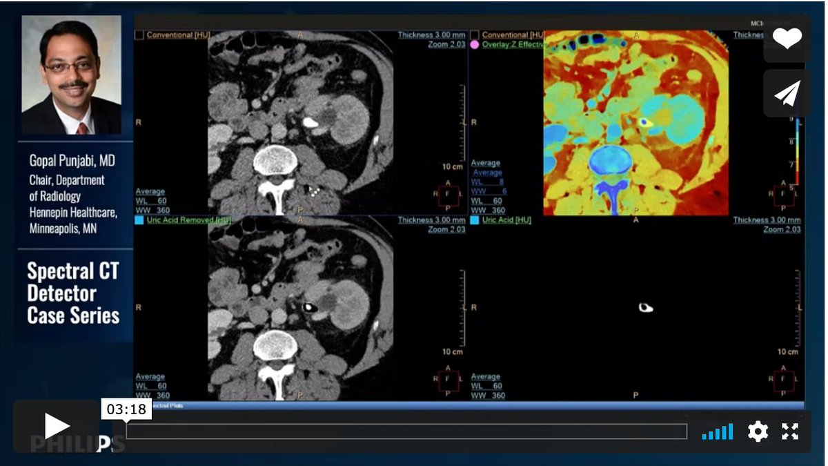 Applied_Rad's tweet photo. #SpectralCT can identify the composition of the stones in the kidneys and detect unsuspected gallstones. See more in this video case study review with Gopal Punjabi, MD. https://t.co/PI5NgDKyXx #RadRes #CTtechnologists #Radiologist @PhilipsHealth @CtSpectral https://t.co/5YgzEjPREH