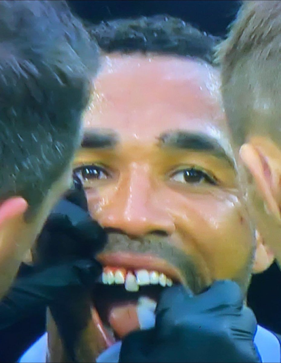 Callum Wilson’s tooth has seen better days 🤢