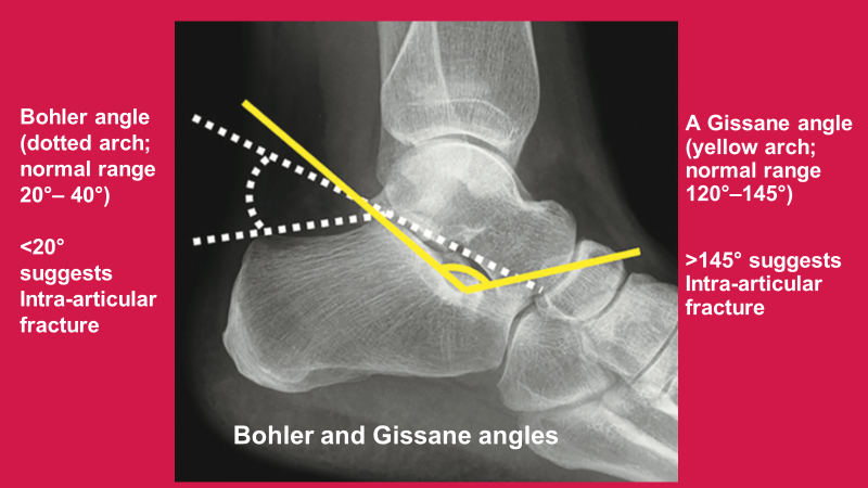 Sameer Raniga On Twitter The Calcaneus Is The Most Frequently