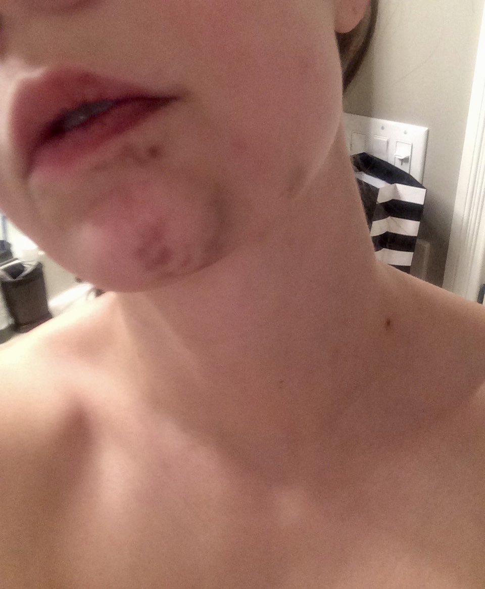 amberskyefair's tweet photo. #camillevasquez is laying out the facts! 
#AmberTurd testimony is a lie and embarrassing to survivor of DV. This is me after being punched by my ex 5x without rings about a 1-1.5 weeks later. #amberheardisapsychopath #AmberHeardIsALiar #DeppHeardTrial https://t.co/VJaO2HK3g8