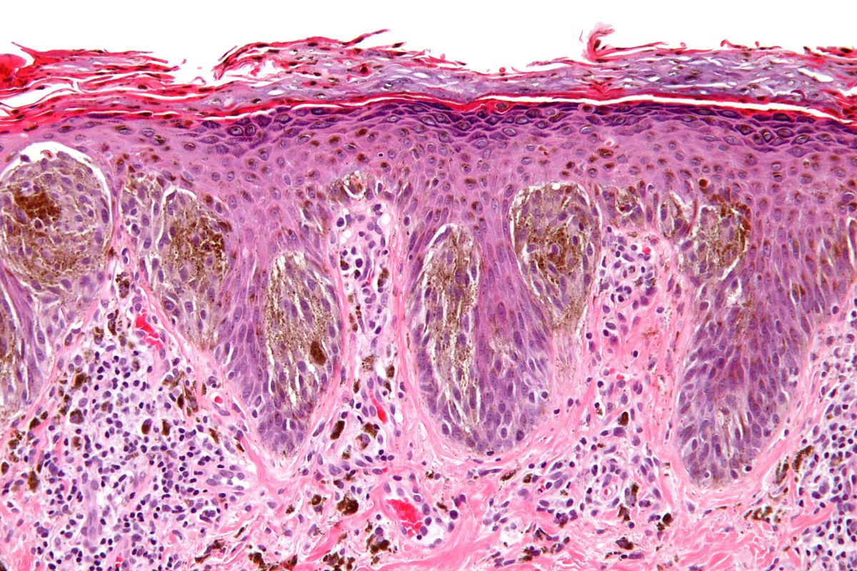 Kamino bodies🧐

📌Eosinophilic globules seen in Spitz nevus
📌Rare in melanoma

Spitz nevus🤔
✅Benign neoplasm composed of large epithelioid or spindled melanocytes in dermis & epidermis
✅Pink papule on extremities or face of adolescents usually

#PathTwitter #ATPathNuggets✨