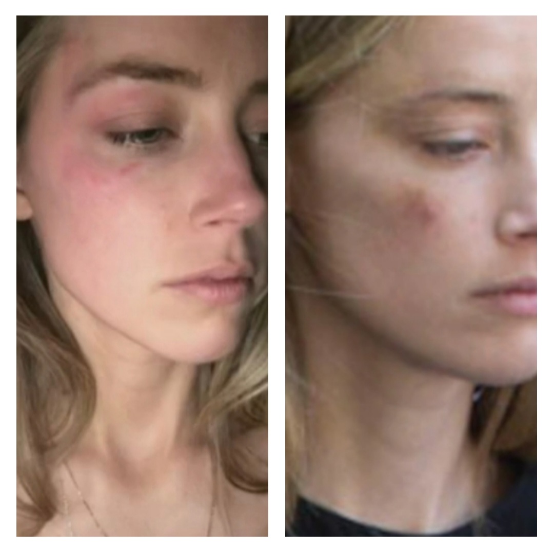 VeeRealReel1's tweet photo. #AmberHeardIsALiar
#AmberHeard words never align with her actions, just as her alleged injuries do not align...ALL LIES
#AmberHeardIsAnAbuser
#Amberturd
#AmberHeardPerjury
#JohnnyDepp
#JohnnyDeppIsAvictim
#JusticeForJohhnyDepp
#JohnnyDeppvAmberHeard
#JohnnyDeppRedemption https://t.co/10qRkTOZAv