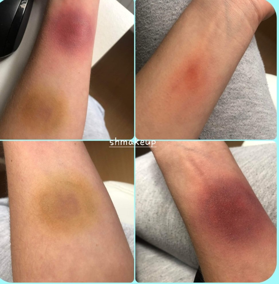 FortheTruthofit's tweet photo. My sister does SFX makeup and this is some examples of bruises she made from a "bruise kit" shows just how easy it is to do!!
#AmberHeardlsALiar
#JohnnyDeppVsAmberHeard
#fakebruises
#DeppVsHeard https://t.co/T76V5ip5Wj