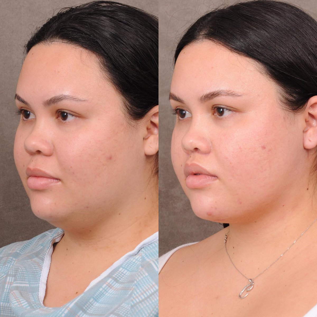 DrBenTalei's tweet photo. Weekend neck lift with CUPID lip lift for our sweet and lovely Hawaiian patient who’s now a few months out and loving it!
#cupidlift #cupidliplift #weekendlift #deeplanenecklift #profoundrf #drbentalei https://t.co/TeR4TvK5p7