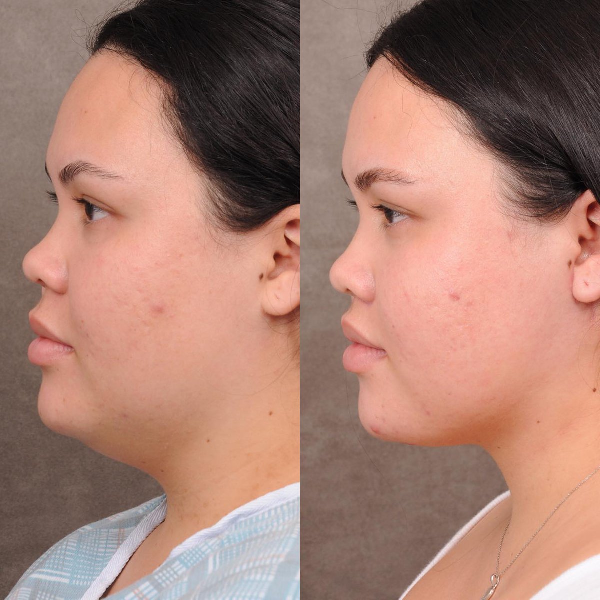DrBenTalei's tweet photo. Weekend neck lift with CUPID lip lift for our sweet and lovely Hawaiian patient who’s now a few months out and loving it!
#cupidlift #cupidliplift #weekendlift #deeplanenecklift #profoundrf #drbentalei https://t.co/TeR4TvK5p7