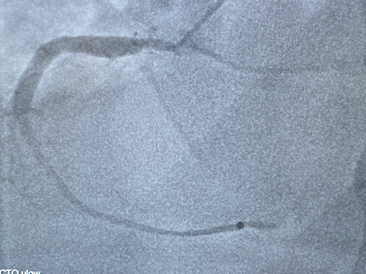 AndWierucki's tweet photo. Post.-lat. STEMI. LCX 9-12 mm diameter. @BotPci #pcicase @KPujdak @rvprog @kaschenke @Obisht @klinki_hh @KardiologieHH https://t.co/Tko2wzlRFr