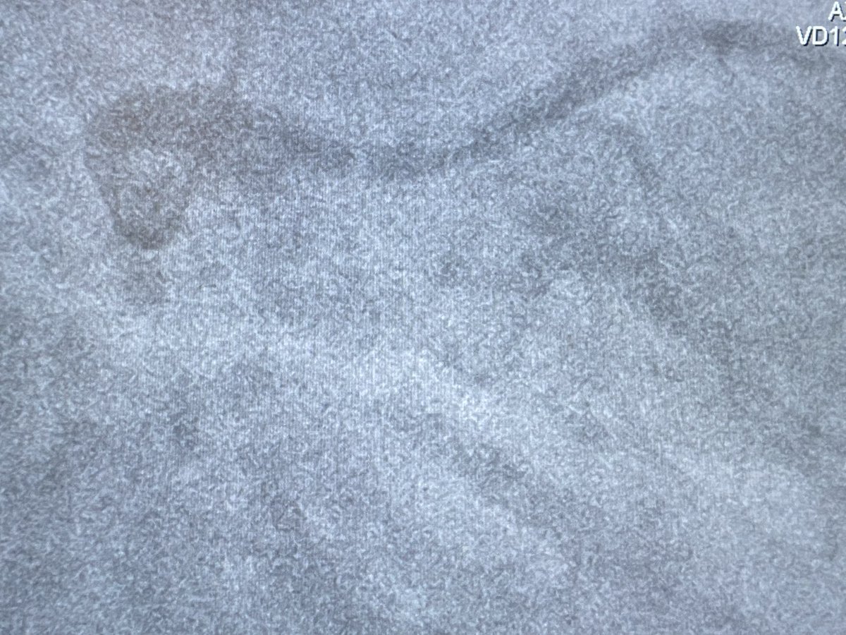AndWierucki's tweet photo. Post.-lat. STEMI. LCX 9-12 mm diameter. @BotPci #pcicase @KPujdak @rvprog @kaschenke @Obisht @klinki_hh @KardiologieHH https://t.co/Tko2wzlRFr