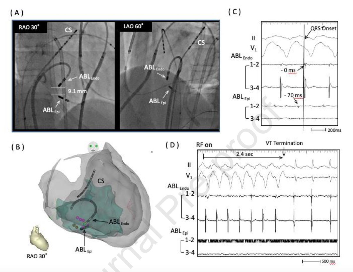 Successful Bipolar Radiofrequency Catheter Ablation in a Case of Scar-related Ventricular Tachycardia with Intramural Critical Isthmus in Basal Posterior Right Ventricle Identified by Coherent Mapping heartrhythmcasereports.com/article/S2214-…