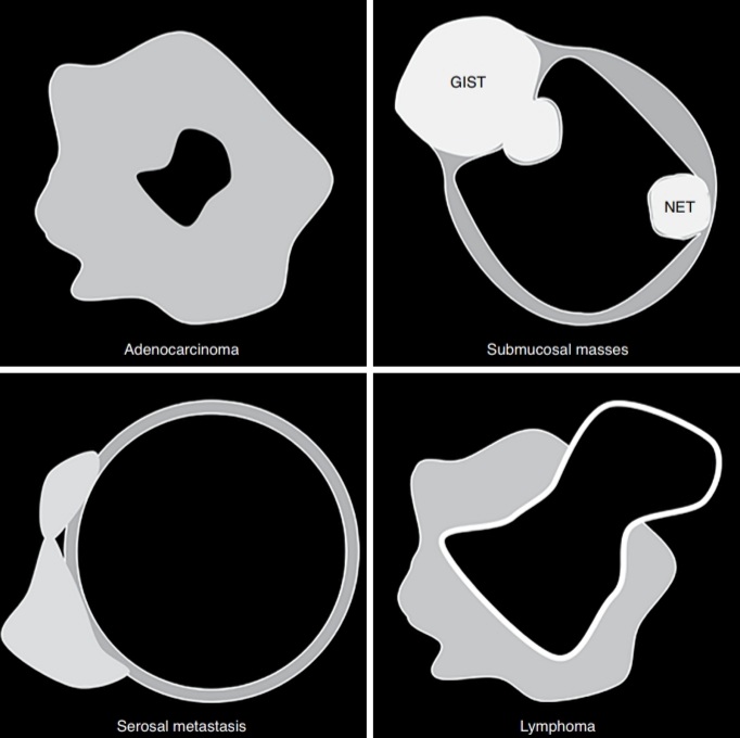 🌕DIAGRAMMATIC REPRESENTATIONS OF COMMON MALIGNANT MASS OF SMALL BOWEL🌕
#MedTwitter #smallbowel #GIST