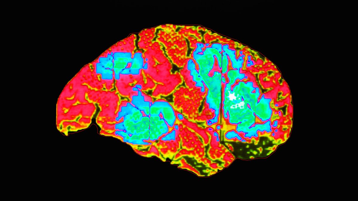 NEW VIDEO: What Happens When You Rub 1 Tube Of Pain Relief Cream Between Your Legs -RT!

A discussion on Salicylate Poisoning

Video: youtu.be/TyIiM-02Iqs
Podcast version: anchor.fm/chubbyemu/epis…