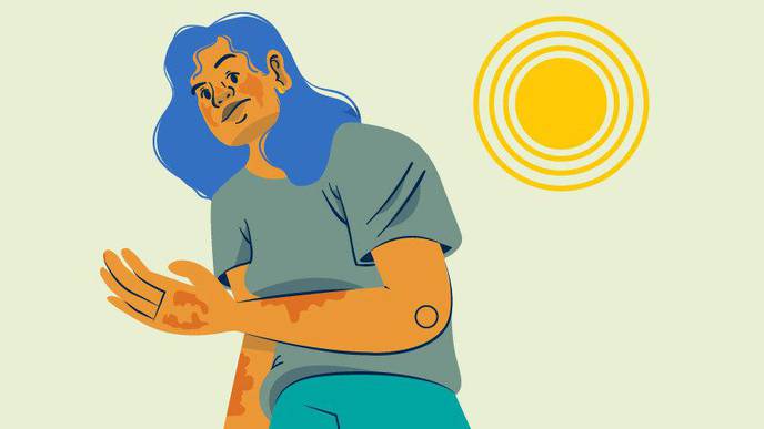 Did you know? Normal-appearing skin on #lupus patients contains the same inflammatory signals that are detected when the skin develops a rash. bit.ly/3MnHnlz #Rheumatology #RheumTwitter