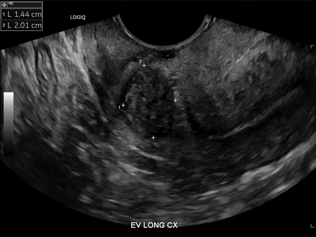 #Fibroids can occur a variety of places, including the cervix. With this location, we were able to complete the myomectomy transcervically and allow the patient to go home same day/return to normal activities the next day.  #minimallyinvasivesurgery at its best! #fibroidawareness