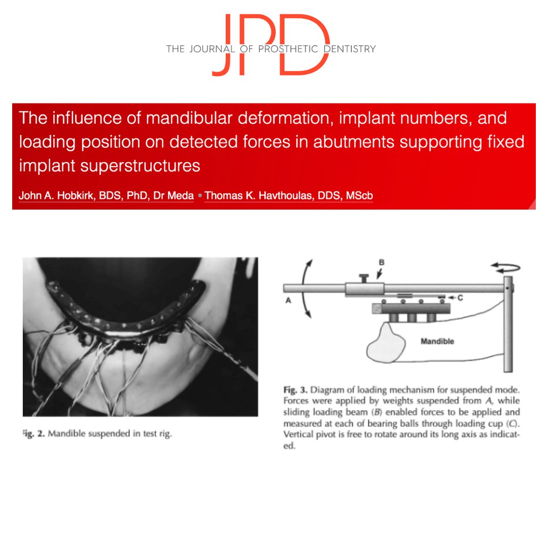 JPDentistry's tweet photo. This #classicarticle studies functional mandibular deformation - the bony response to force- that occurs with different number of implants and loading directions in a splinted #implant supported #fixeddentalprosthesis.

Learn more: https://t.co/LclzrtNypy https://t.co/f4x42jWwfk
