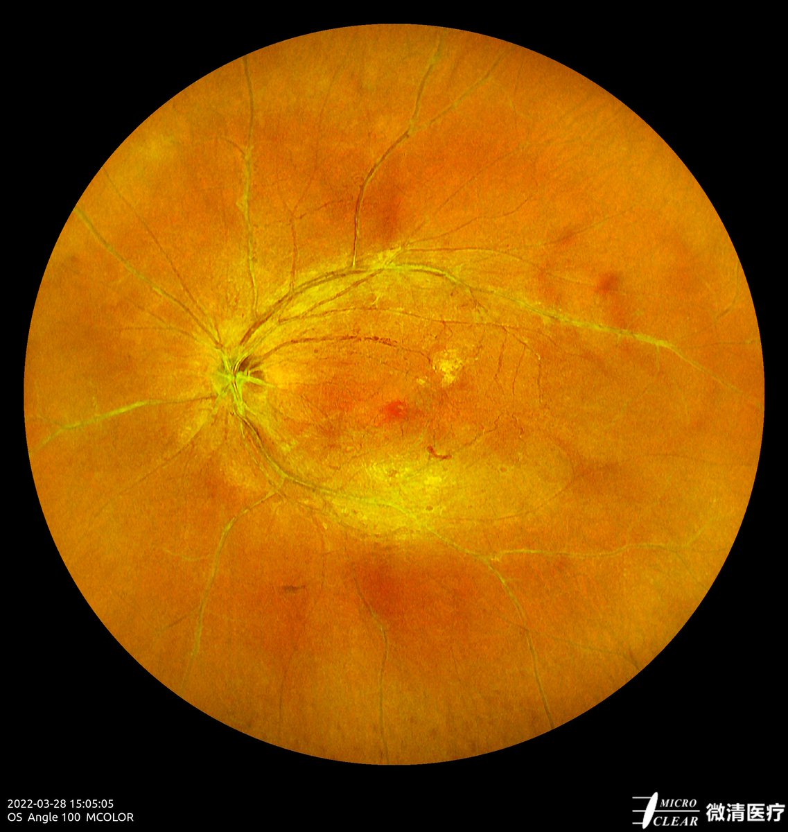 Microcleartec's tweet photo. Diabetic Retinopathy #DR
Picured by Apollo, the #ConfocalRetinalOphthalmoscope
#retinopathy #autofluorescence #fluorescenceangiography #funduscamera #retinaldiseases #Oct #laserscanning https://t.co/6d6uUVVmFd