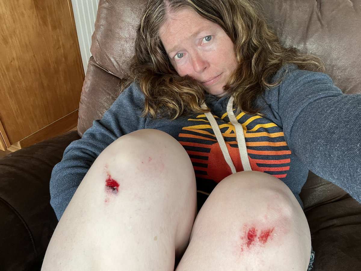catbiri2's tweet photo. I hurt. I am proud of myself though because after I fell, while I was walking, I could feel all my muscles tensing so I purposely focused on relaxing then each time I noticed, so I hurt less than I could have. https://t.co/obYUtwWOXz