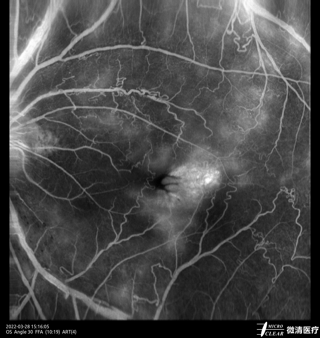 Microcleartec's tweet photo. Diabetic Retinopathy #DR
Picured by Apollo, the #ConfocalRetinalOphthalmoscope
#retinopathy #autofluorescence #fluorescenceangiography #funduscamera #retinaldiseases #Oct #laserscanning https://t.co/6d6uUVVmFd