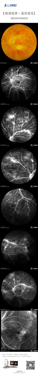 Diabetic Retinopathy #DR
Picured by Apollo, the #ConfocalRetinalOphthalmoscope
#retinopathy #autofluorescence #fluorescenceangiography #funduscamera #retinaldiseases #Oct #laserscanning
