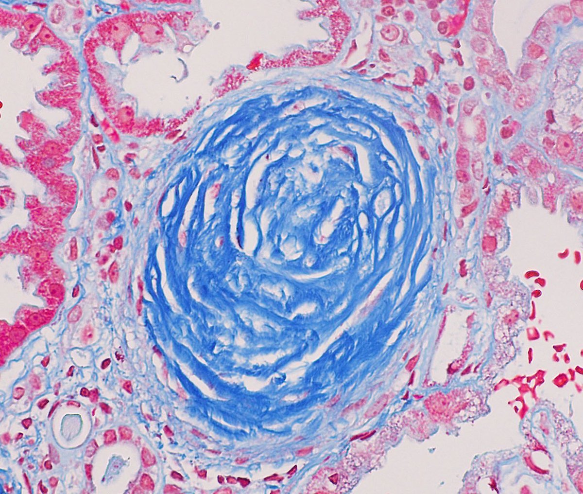 Amy Yau (@amyaimei) on Twitter photo What are these weird acellular peritubular sclerosing nodules?! #renalpath #vonrecklinghausen #neurofibromatosis
Cool write up and case by <a href="/UAZMedTucson/">UA College of Medicine – Tucson</a> student doctor Priscilla Cortez!
rdcu.be/cNw6I What are these weird acellular peritubular sclerosing nodules?! #renalpath #vonrecklinghausen #neurofibromatosis
Cool write up and case by <a href="/UAZMedTucson/">UA College of Medicine – Tucson</a> student doctor Priscilla Cortez!
rdcu.be/cNw6I