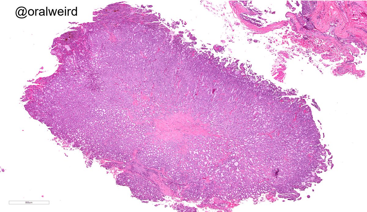 Male in his 40s with a buccal mucosal mass
▶️What do you think?
▶️What IHC would you order?

Diagnosis on Friday!