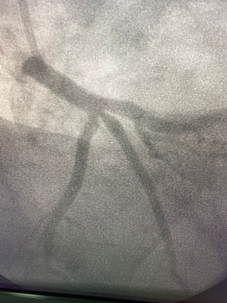 fabio_pinton's tweet photo. 54yo female, HTN, atypical symptoms + palpitations. How would you evaluate this lesion? And how would you treat it? Pool below @GreggWStone @LAzzaliniMD @GoranEBC @BifurcationClub @mirvatalasnag @mmamas1973 @JEscaned @evandrofilhobr @CMichaelGibson https://t.co/qA0tYdzkEw