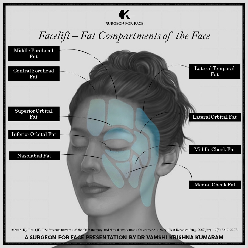 SurgeonforFace's tweet photo. Fat compartments of the face
A wonderful article by @DrRodRohrich
#facelift #rodrohrich #rodrohrichmd #fatpads #facialfatpads #facialfat #fat #youthfulface #plumpyface #youngface #facialrejuvenation #rejuvenationofface #surgeonforfaceknowledge
#surgeonforface #vamshikumaram https://t.co/YZXGADOR6K