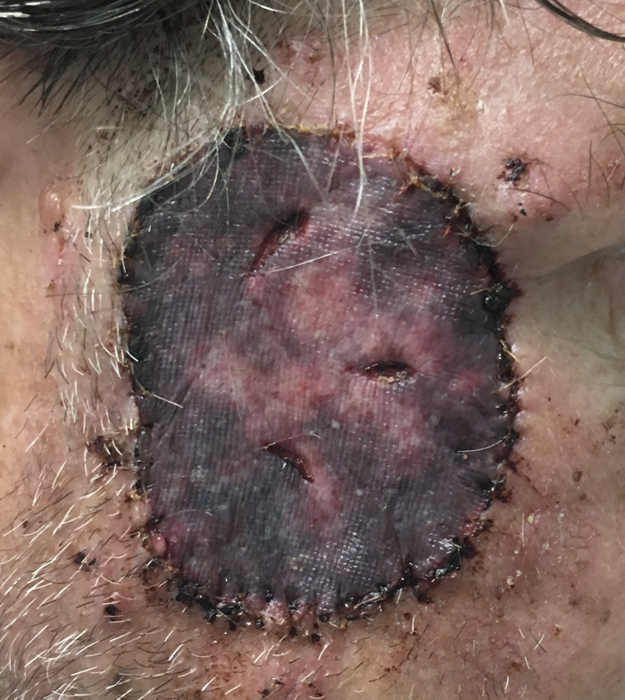 ManualofSurgery's tweet photo. Two new chapters: Prone Position with @sundg01 and Full Thickness Skin Grafting. 
Authors welcome! Write here or to my email on the website!
@VUMCGlobalSurg
 #SoMe4Surgery #globalsurgery 

https://t.co/LHI79VGTXY https://t.co/bacdMOCatc