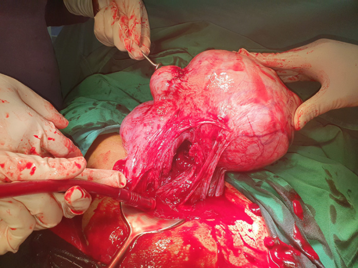 medizzycom's tweet photo. Case Study: Large Uterine Fibroids
https://t.co/6qz6QUMuJc
#MedTwitter #obgyn #MEDizzy https://t.co/s0feo4WZo2