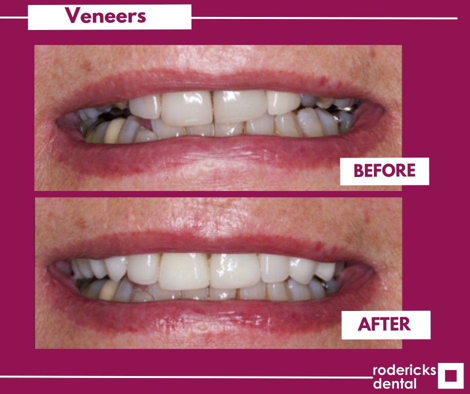 rodericksdental's tweet photo. Transformation Tuesday!

We had an amazing transformation done by Dr Amrinder Singh Baidwan, our Dentist at Wootton Dental Practice.

If you would like to book a consultation for veneers, please follow the link below.
https://t.co/xcM8hp1Cy1
#Dentist #Transformation #Invisalign https://t.co/dUi1TuM4Ae