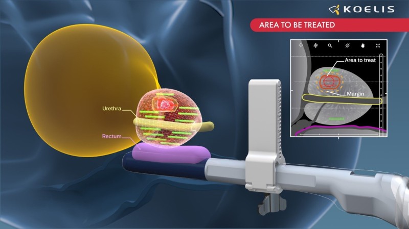 KebomedUKUro's tweet photo. We're hearing some fantastic feedback from UK surgeons coming back from #AUA22 about the innovations they saw at the @KoelisBx stand. If you want to know more about the cutting edge tech Koelis have been working on, contact with us @KebomedUK
#ProMap_Lite™ #ProMap_FT™ #Perine https://t.co/EsReATLWNr