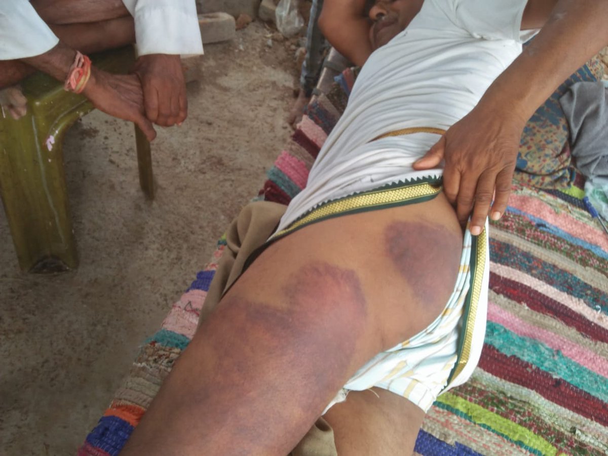 RamlalCharpota5's tweet photo. बासँवाड़ाभूंगड़ा थाने की घटना पुलिस की गुंडागर्दी आदिवासी के घर मे रात 11 बजे जबरन हमला कर देना बुजर्ग को मारना महिलाओं।से छेड़खानी करना यही कानून है क्या ?उक्त दोषी पुलिसकर्मियों के खिलाफ कानूनी कार्यवाही होकर आदिवासी के साथ न्याय करे 
@RajCMO 
@PoliceRajasthan 
@BanswaraPolice https://t.co/R0QpM7uU9W