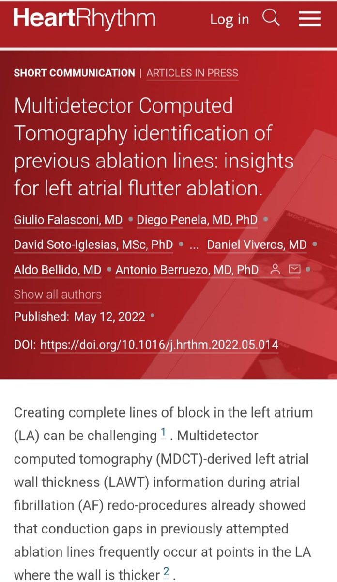 Giulio Falasconi, MD (@drfalasconi) on Twitter photo Another amazing experience with <a href="/ADAS3D/">ADAS3D Medical</a> . MDCT-derived LAWT-aided left atrial flutter ablation. Great team! <a href="/DrBerruezo/">DrAntonioBerruezo</a> <a href="/diegopenela1/">diego penela</a> <a href="/Davidsotoiglesi/">David soto-iglesias</a> <a href="/julio93383971/">Julio Martí Almor</a> <a href="/DrCherylTeresEP/">Cheryl Teres</a> <a href="/daniviverosf/">Daniel Viveros</a> <a href="/JAldereteM/">José Alderete M</a> <a href="/Dra_Scherer/">Claudia Scherer</a> <a href="/paulafrancocana/">Paula Franco</a> <a href="/Clinica_Teknon/">Centro Médico Teknon</a> <a href="/OpenHeart_EU/">OpenHeart Foundation</a> Another amazing experience with <a href="/ADAS3D/">ADAS3D Medical</a> . MDCT-derived LAWT-aided left atrial flutter ablation. Great team! <a href="/DrBerruezo/">DrAntonioBerruezo</a> <a href="/diegopenela1/">diego penela</a> <a href="/Davidsotoiglesi/">David soto-iglesias</a> <a href="/julio93383971/">Julio Martí Almor</a> <a href="/DrCherylTeresEP/">Cheryl Teres</a> <a href="/daniviverosf/">Daniel Viveros</a> <a href="/JAldereteM/">José Alderete M</a> <a href="/Dra_Scherer/">Claudia Scherer</a> <a href="/paulafrancocana/">Paula Franco</a> <a href="/Clinica_Teknon/">Centro Médico Teknon</a> <a href="/OpenHeart_EU/">OpenHeart Foundation</a>
