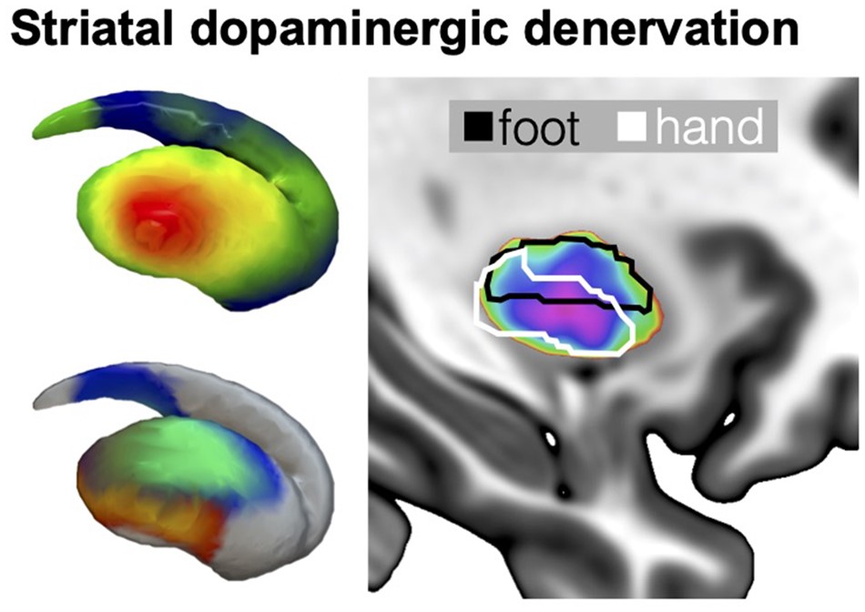 Pineda-Pardo et al. show that striatal dopaminergic denervation in early Parkinson’s disease follows a somatotopic pattern, beginning with the upper limb representation in the putamen. The changes correlate with the evolution of motor features. bit.ly/3F1obHn